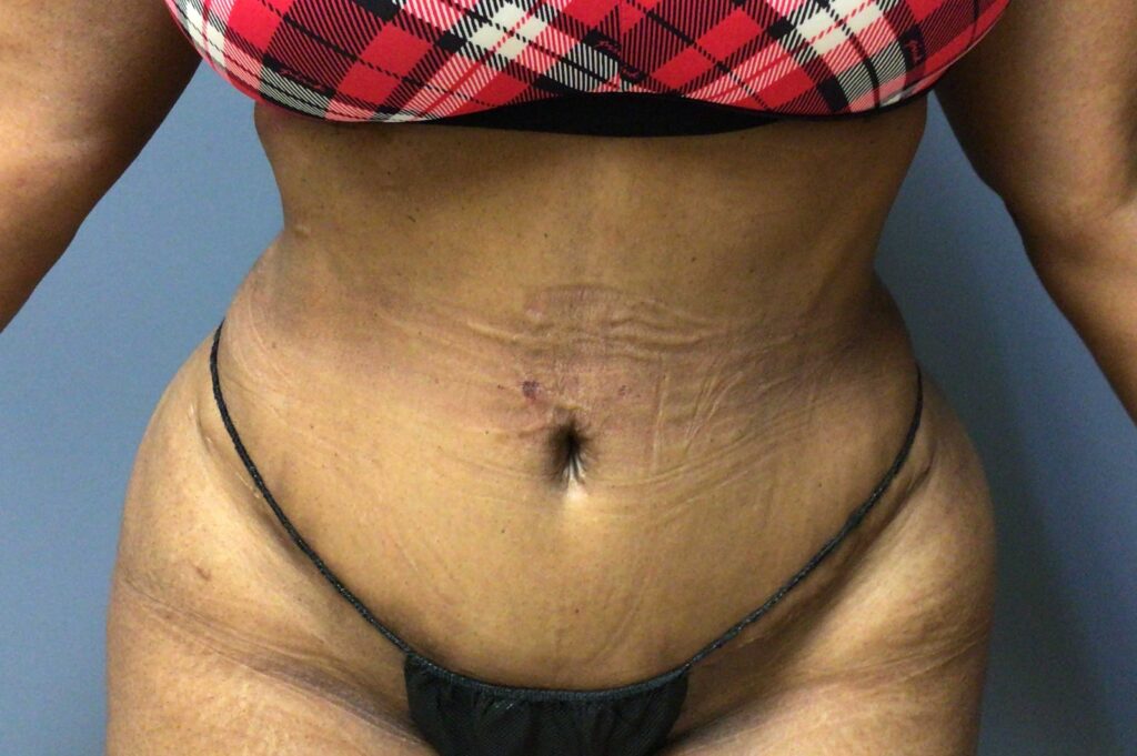 56 year old female one year post op