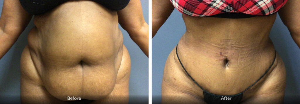 56 year old tummy tuck before and after