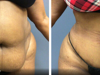 56 year old tummy tuck before and after