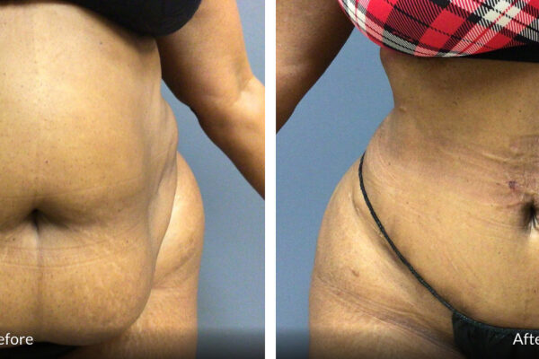 56 year old tummy tuck before and after