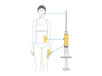 Beauty woman make fat transfer from buttocks to facial for wrinke