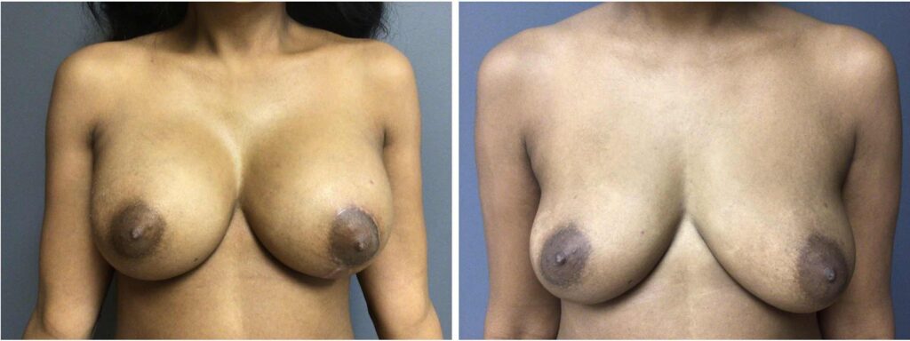 before and after 36 year old bilateral breast augmentation with left lift