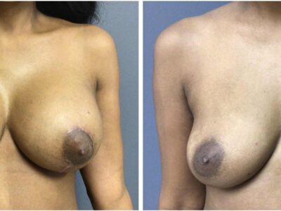 before and after 36 year old bilateral breast augmentation with left lift