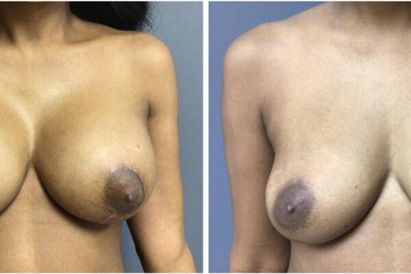 before and after 36 year old bilateral breast augmentation with left lift