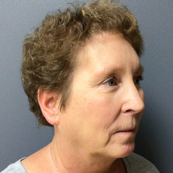 62 year old female 8 months post op browlift and lower blepharoplasty