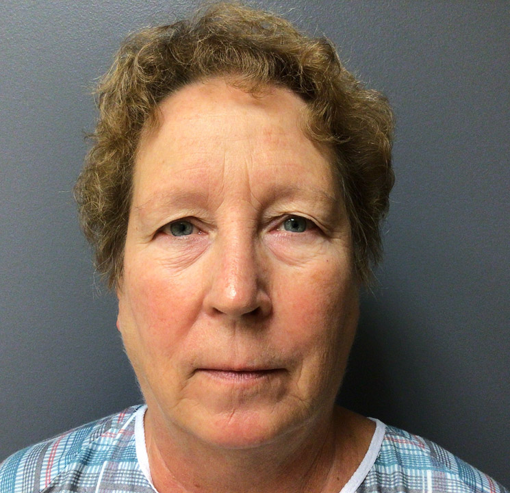 62 year old female presents for browlift and lower bleph
