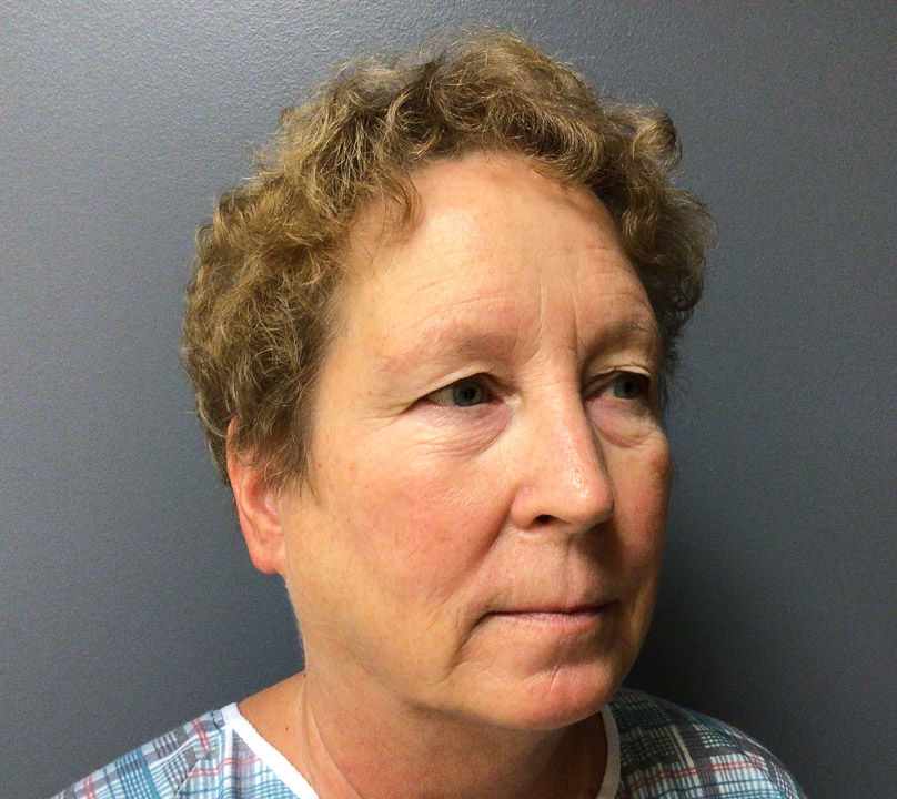 62 year old female side view preop browlift and lower blepharoplasty