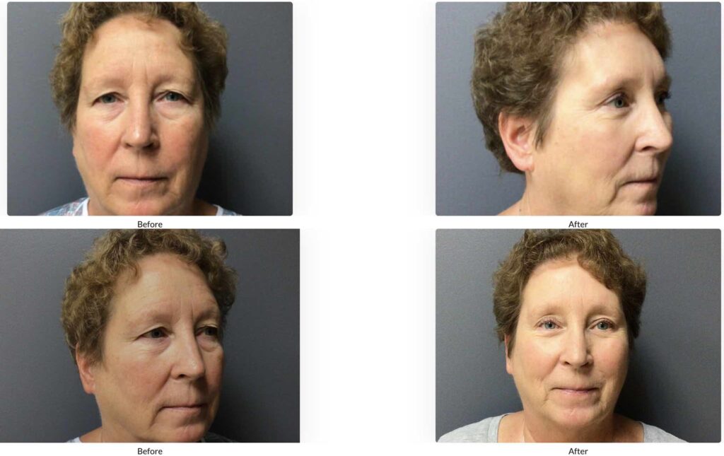 62 year old eyelid lift and brow lift