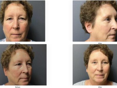 62 year old eyelid lift and brow lift