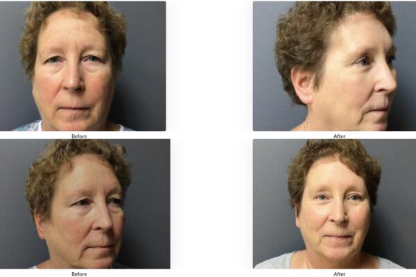 62 year old eyelid lift and brow lift