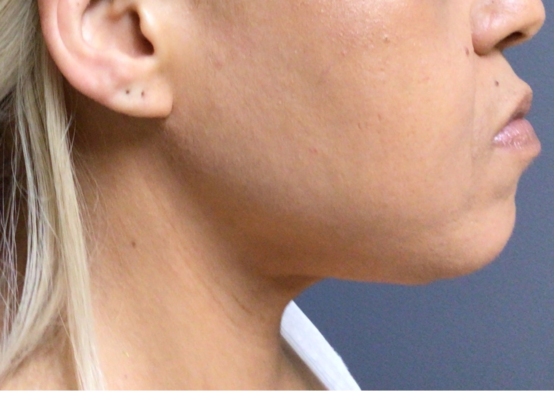 A 39-year-old female presented for a neck lift procedure. She was unhappy with the looseness of her skin after weight loss. She underwent a neck lift procedure and was very happy with her results. Photos are 8 months postop.