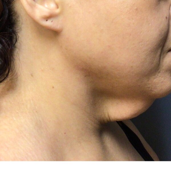 A 39-year-old female presented for a neck lift procedure. She was unhappy with the looseness of her skin after weight loss. She underwent a neck lift procedure and was very happy with her results. Photos are 8 months postop.