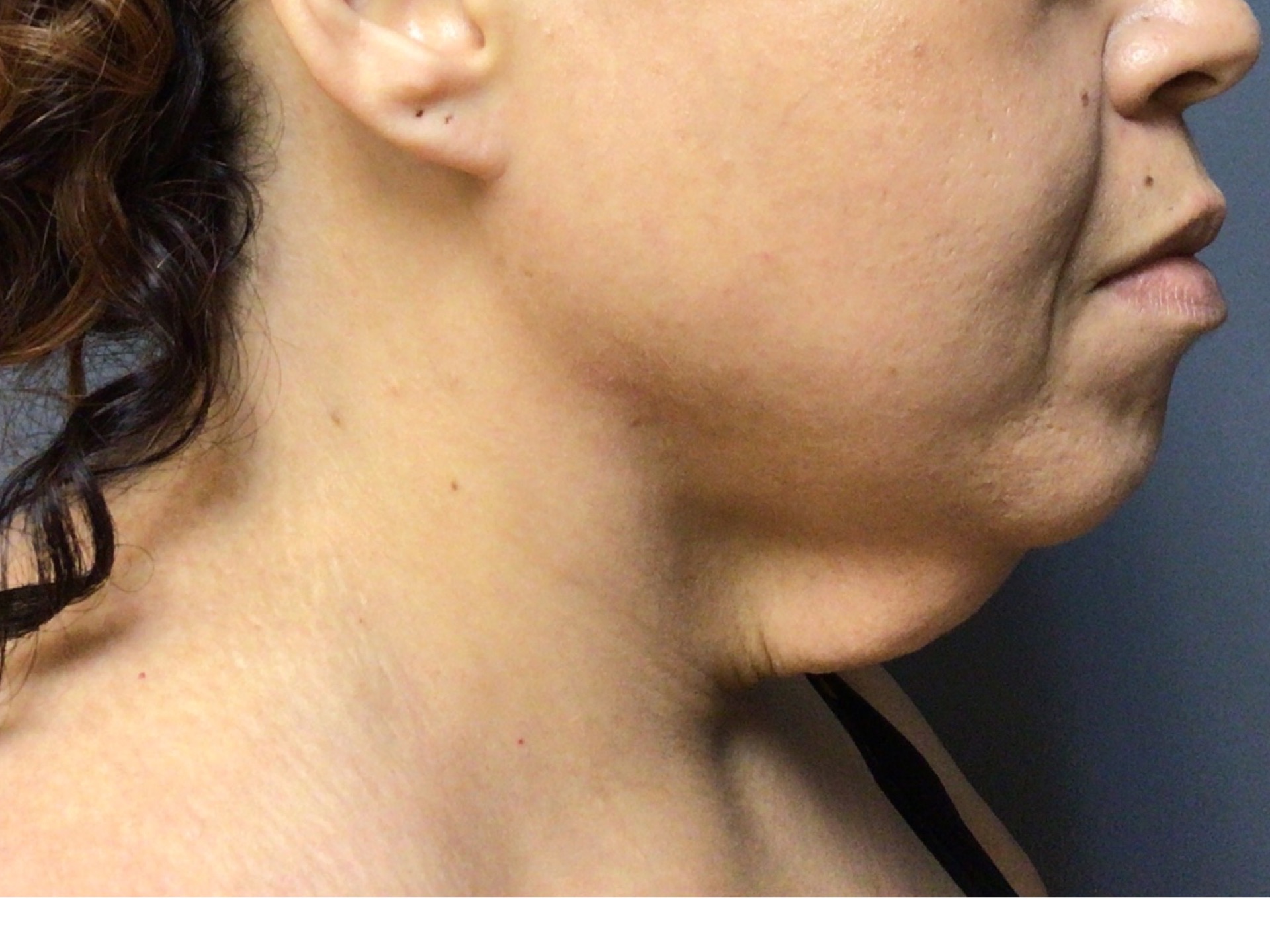 A 39-year-old female presented for a neck lift procedure. She was unhappy with the looseness of her skin after weight loss. She underwent a neck lift procedure and was very happy with her results. Photos are 8 months postop.