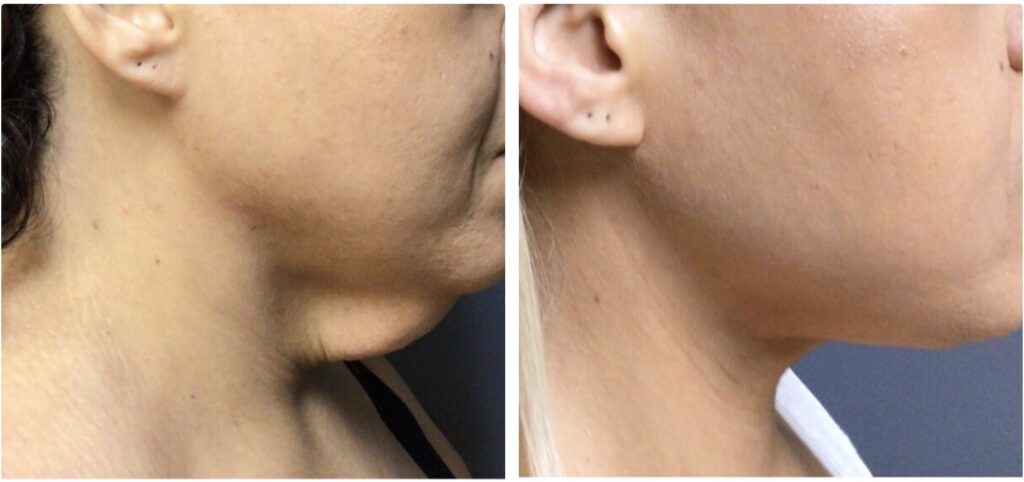 A 39-year-old female presented for a neck lift procedure. She was unhappy with the looseness of her skin after weight loss. She underwent a neck lift procedure and was very happy with her results. Photos are 8 months postop.