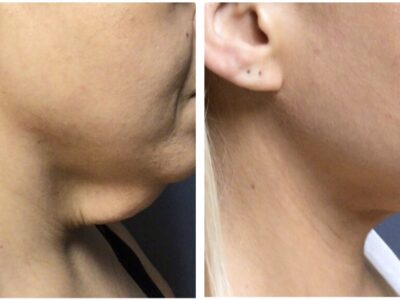 A 39-year-old female presented for a neck lift procedure. She was unhappy with the looseness of her skin after weight loss. She underwent a neck lift procedure and was very happy with her results. Photos are 8 months postop.