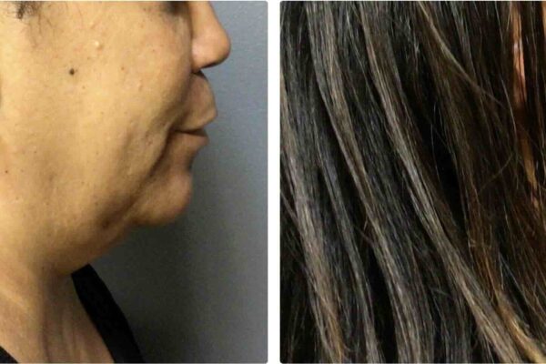 before and after of a 58 year old profound treatment