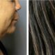 before and after of a 58 year old profound treatment