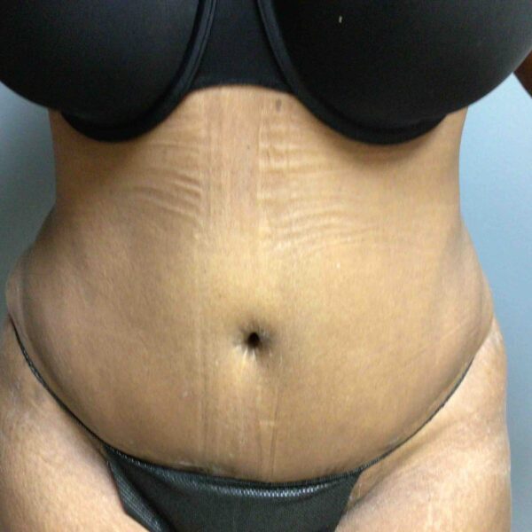 55 year old female 3 months postop tummy tuck front view