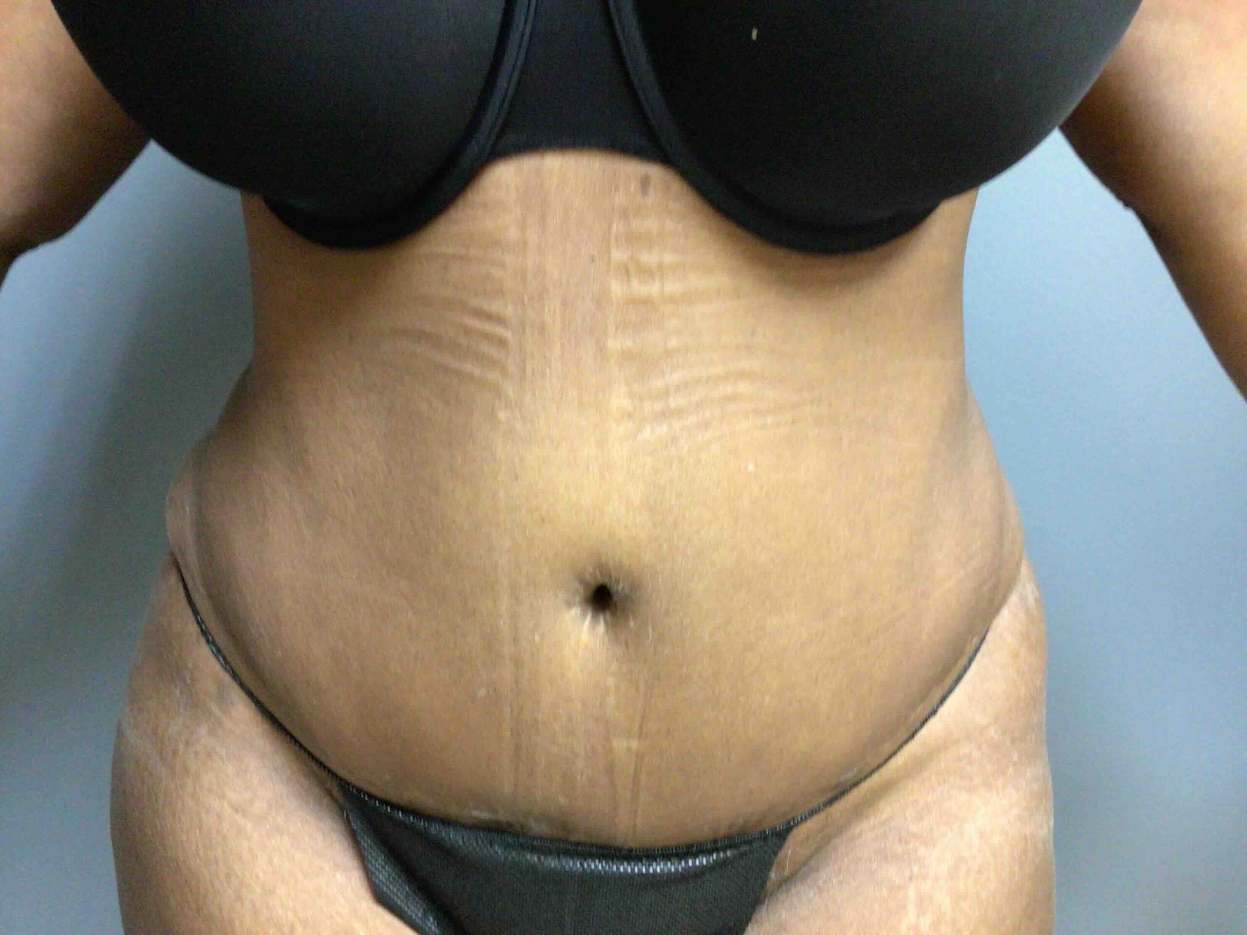 55 year old female 3 months postop tummy tuck front view