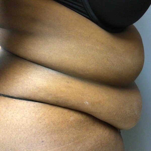 55 year old female pre op abdominoplasty front view