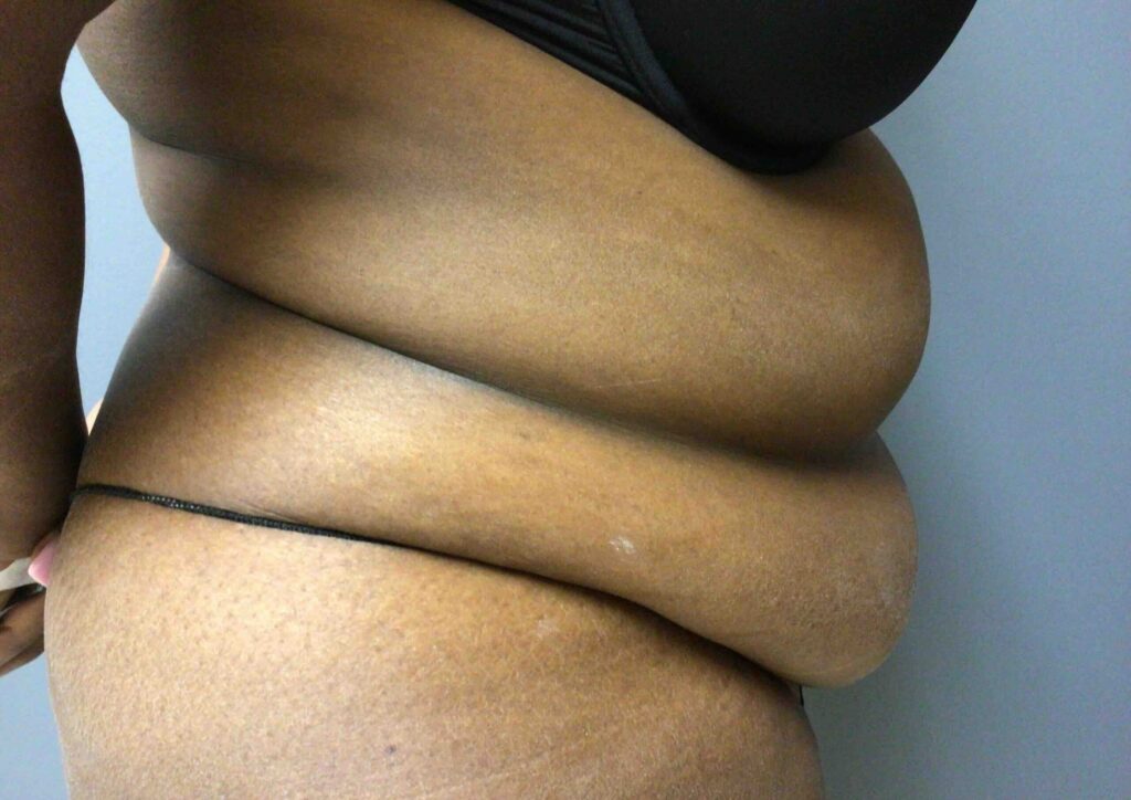 55 year old female pre op abdominoplasty front view