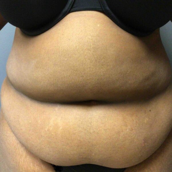 55 year old female preop abdominoplasty front view
