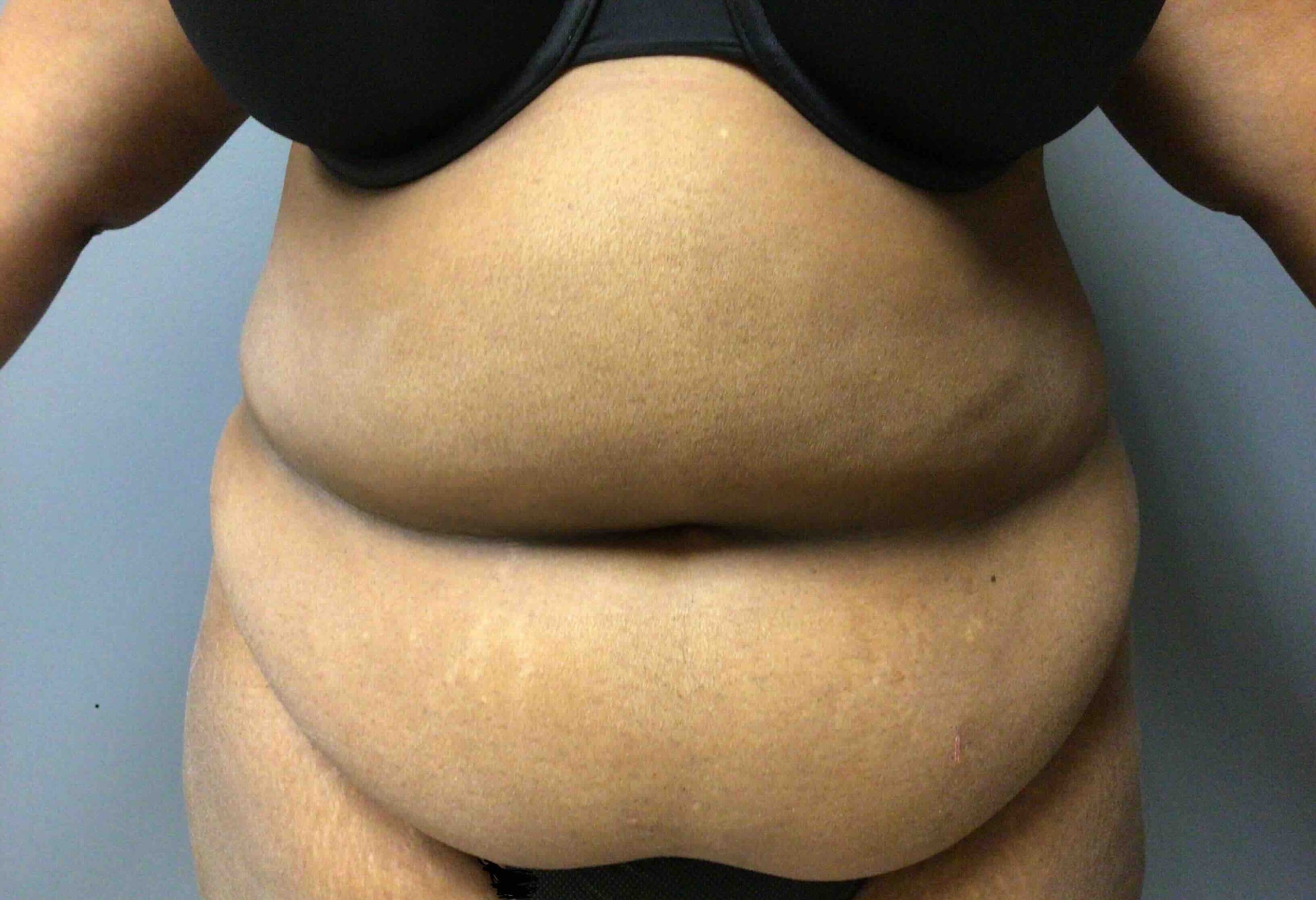 55 year old female preop abdominoplasty front view