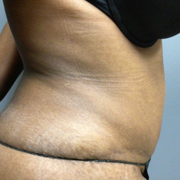 55 year old female right side view 3 months post op tummy tuck