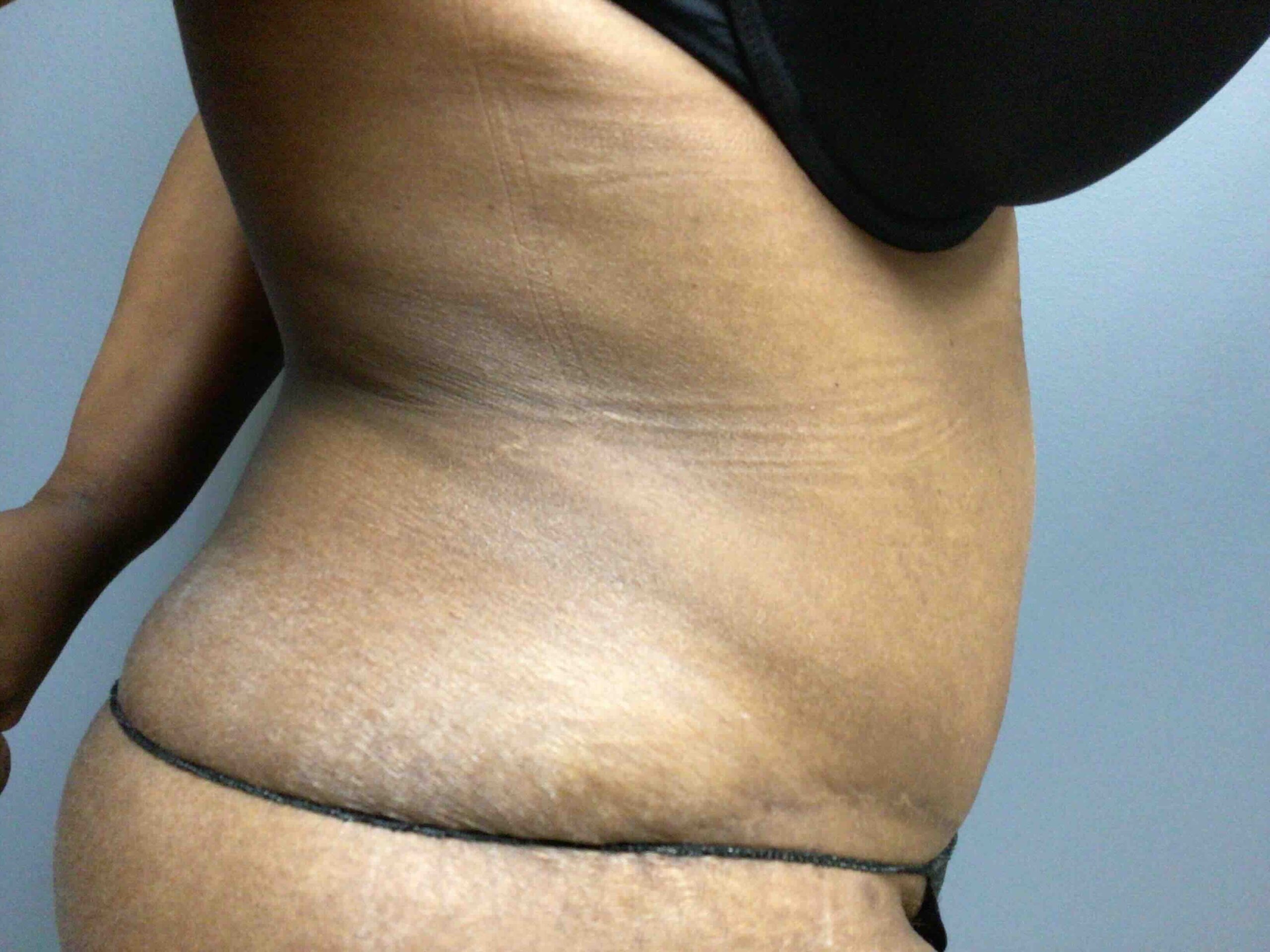55 year old female right side view 3 months post op tummy tuck