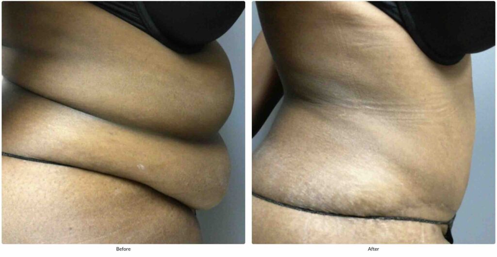 A 55-year-old female presented for an abdominoplasty before and after tummy tuck