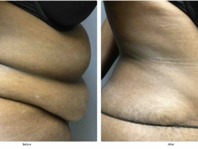 A 55-year-old female presented for an abdominoplasty before and after tummy tuck