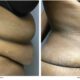 A 55-year-old female presented for an abdominoplasty before and after tummy tuck