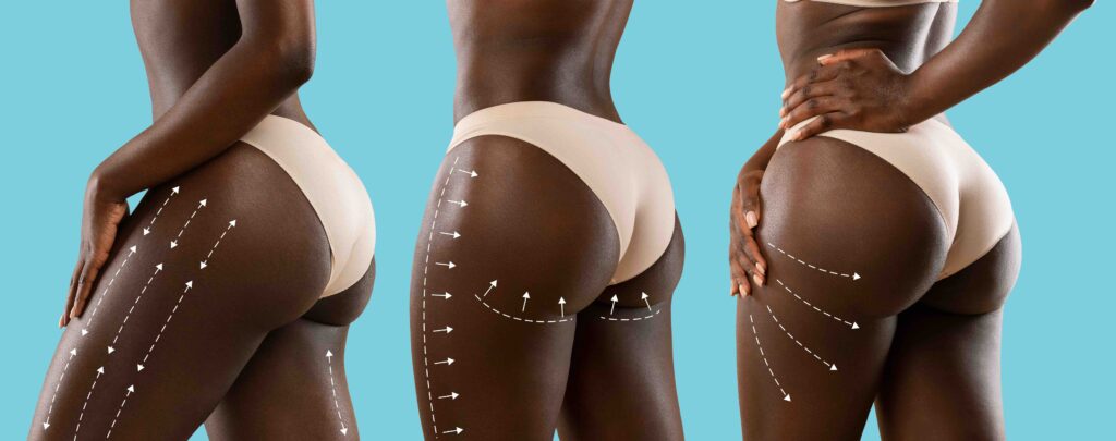 Young african american women in beige lingerie with perfect skin with lines for body shaping or drainage massage, isolated on blue background. Perfect fit female, plastic surgery, brazilian butt lift