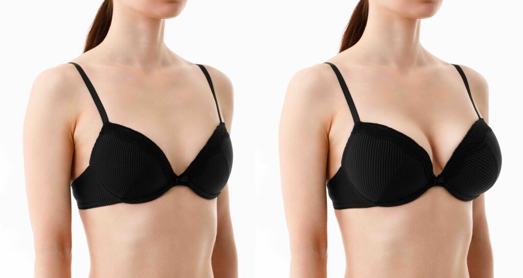 Bust of a woman before and after breast augmentation surgery. Woman in bra with different sizes of breast on white background. Plastic surgery concept