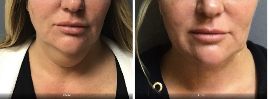 This 49-year-old female did not like the appearance of her chin, especially its fullness from the front or side view. She underwent Vaser liposuction of her chin. At three weeks, she was thrilled with her results. She expects continued improvement since this is early in the postoperative period.