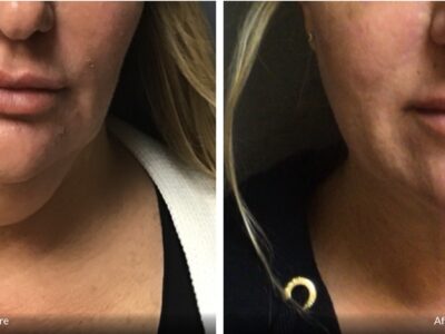 This 49-year-old female did not like the appearance of her chin, especially its fullness from the front or side view. She underwent Vaser liposuction of her chin. At three weeks, she was thrilled with her results. She expects continued improvement since this is early in the postoperative period.