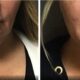 This 49-year-old female did not like the appearance of her chin, especially its fullness from the front or side view. She underwent Vaser liposuction of her chin. At three weeks, she was thrilled with her results. She expects continued improvement since this is early in the postoperative period.