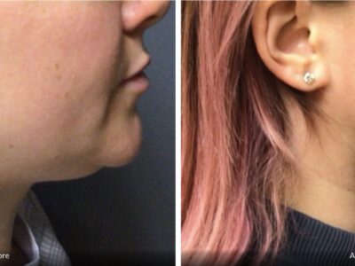 A 34-year-old female did not like the appearance of her chin, especially from the side view. She underwent Vaser liposuction of her chin and is very happy with her results three months post-op.