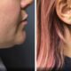 A 34-year-old female did not like the appearance of her chin, especially from the side view. She underwent Vaser liposuction of her chin and is very happy with her results three months post-op.