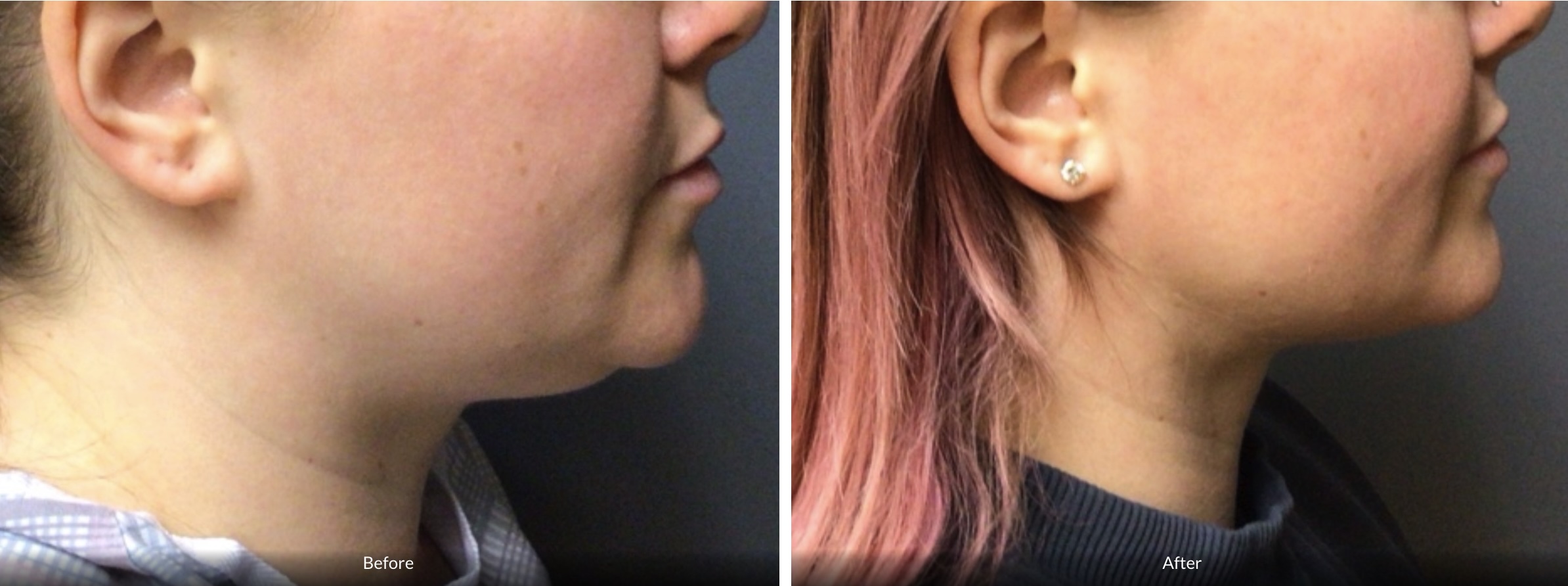 A 34-year-old female did not like the appearance of her chin, especially from the side view. She underwent Vaser liposuction of her chin and is very happy with her results three months post-op.