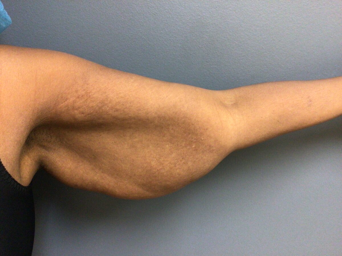 before left arm
