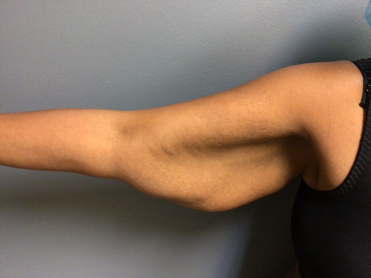 before right arm