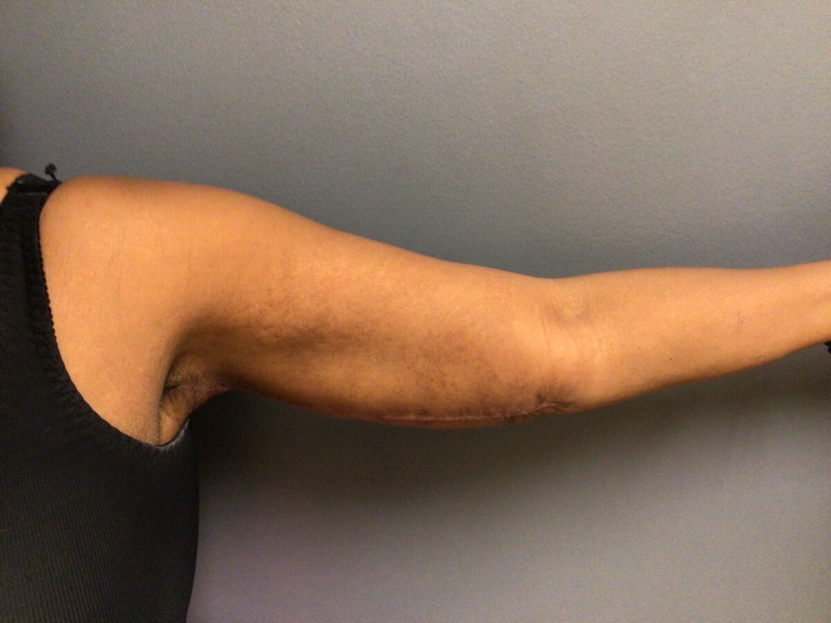 after left arm, 3 months post op