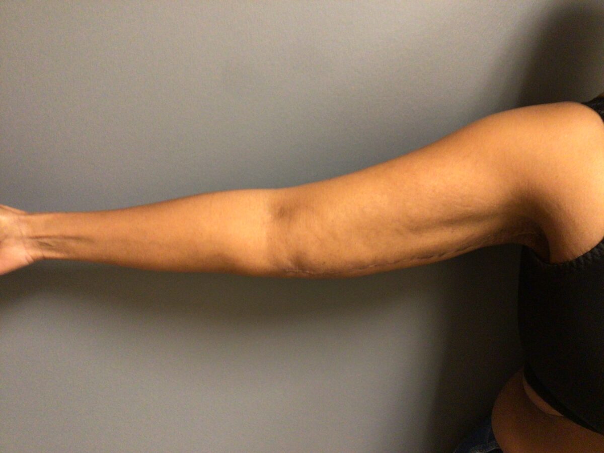 after right arm, 3 months post op