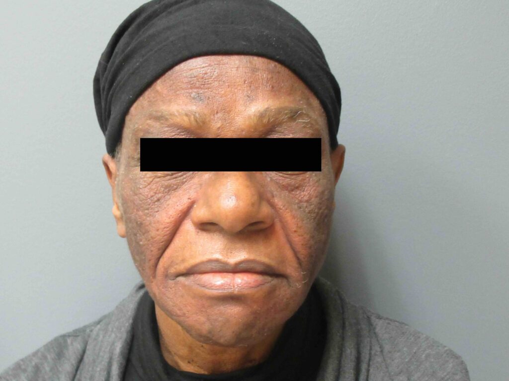 before fraxel laser