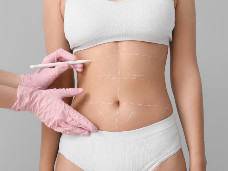 tummy tuck vs mommy makeover