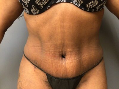 48 year old female 5’7 190 lbs 6 weeks After an Abdominoplasty, Front