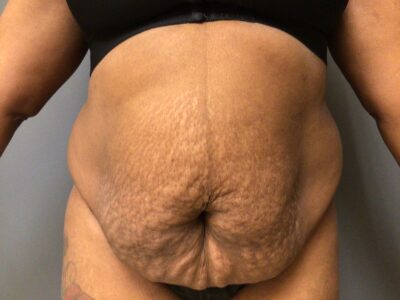 48 year old female 5’7 190 lbs Before an Abdominoplasty, Front