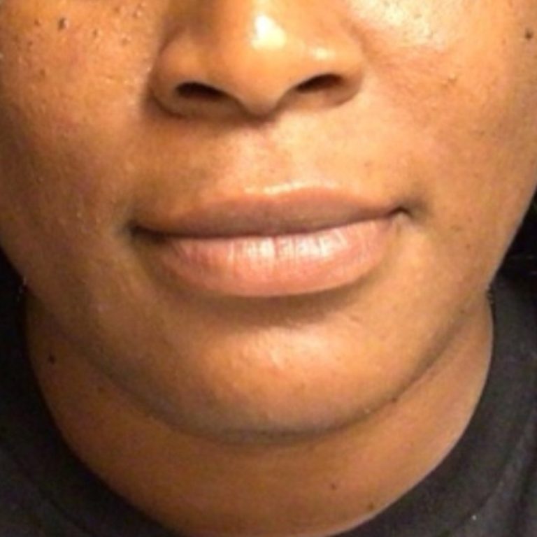 Chin liposuction 6 months after VASER — 37-year-old woman, front view