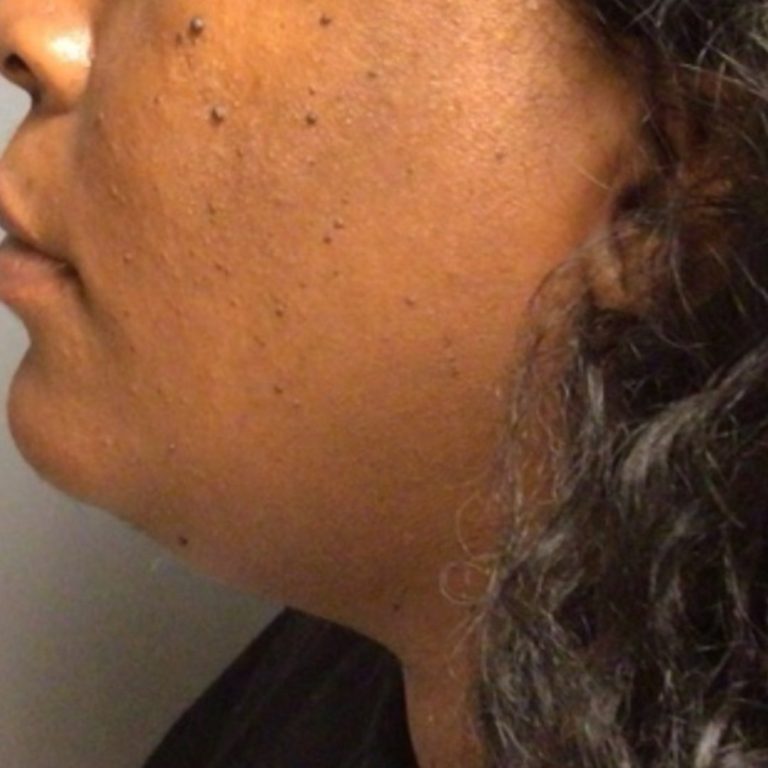 Chin liposuction 6 months after VASER — 37-year-old woman, left side view